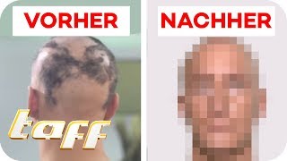 Kreisrunder Haarausfall nach Unfall Kann man das retten  SOS  Einsatz der BeautyRetter  taff [upl. by Flavia593]