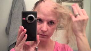 Road to balddom Last 5 days of Chemo hair loss Process [upl. by Ayekat391]