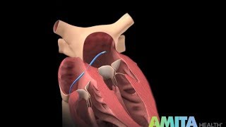 Atrial Fibrillation Mechanisms and Treatment [upl. by Ittam]