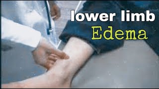 lower limb edema examination [upl. by Jorin]