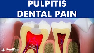 Pulpitis  Inflammation of tooth pulp © [upl. by Keefe]