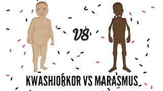 SAM  Severe Acute Malnutrition  Kwashiorkor VS Marasmus [upl. by Rafferty]