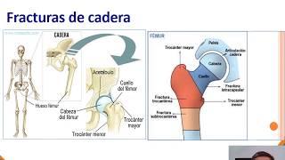 fracturas de cadera [upl. by Eleumas393]