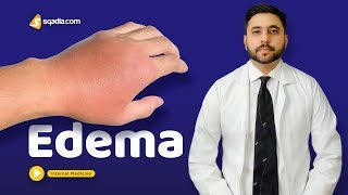 Edema  Medicine Video Lectures  Medical Student Education  VLearning  sqadiacom [upl. by Nivi]