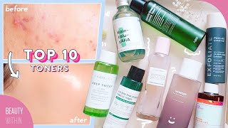 Best Toners for Acne Hyperpigmentation Large Pores Whiteheads amp Blackheads [upl. by Axela]