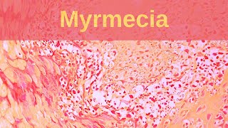 Deep Palmoplantar Wart Myrmecia  Pathology mini tutorial [upl. by Marice779]