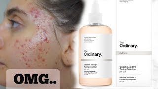 I Tested The Ordinary Glycolic Acid Toner Every Day For A Week  These are my thoughts [upl. by Atillertse]