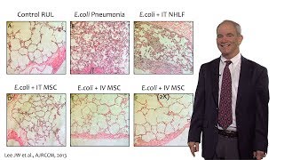 Cancer Epithelial mesenchymal transition in carcinoma 211 [upl. by Erual928]